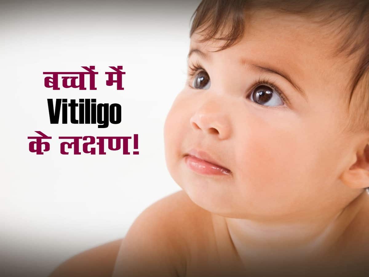 होंठों के आस-पास की स्किन हुई सफेद तो आपको हुआ Vitiligo,बच्चों को इन दो अंगों पर पहले दिखते हैं लक्षण
